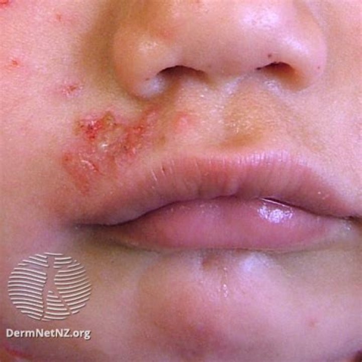 Can you get impetigo in your nose?