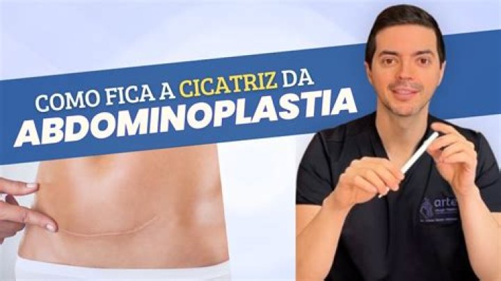 Como funciona a miniabdominoplastia?