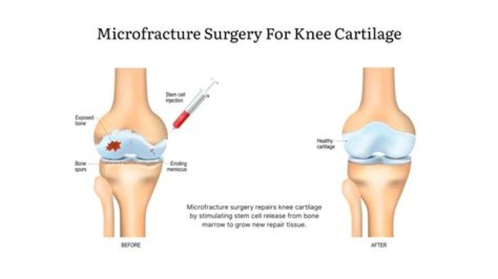 How long does it take for cartilage to grow back after microfracture?
