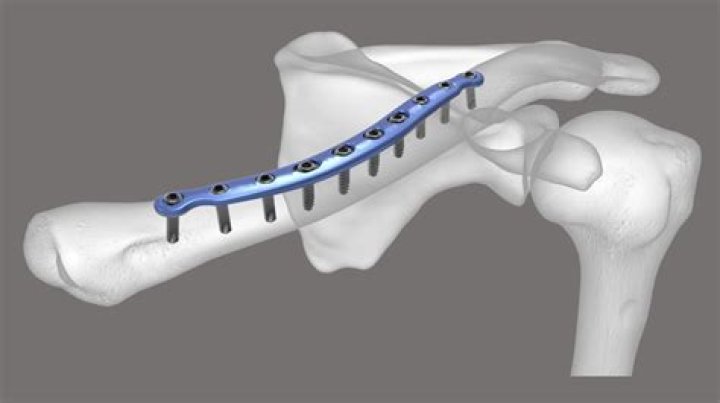 How long does Orif clavicle surgery take?