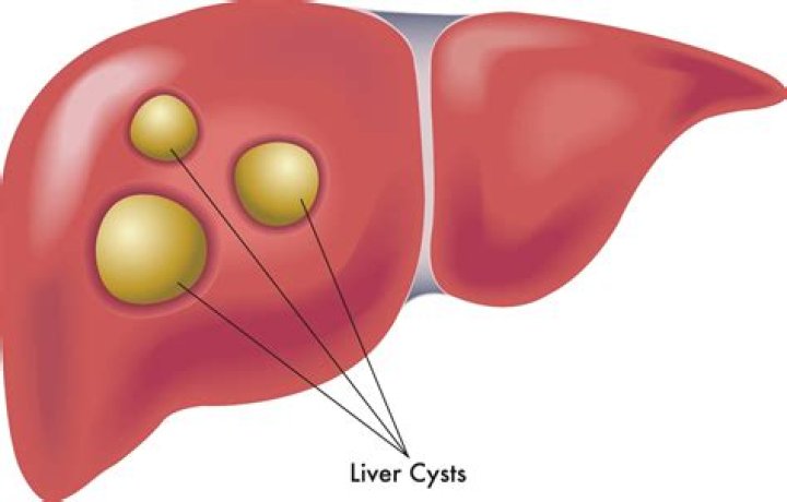What is the most common symptom of a simple liver cyst?
